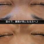 目の下、眉間気になりませんか？